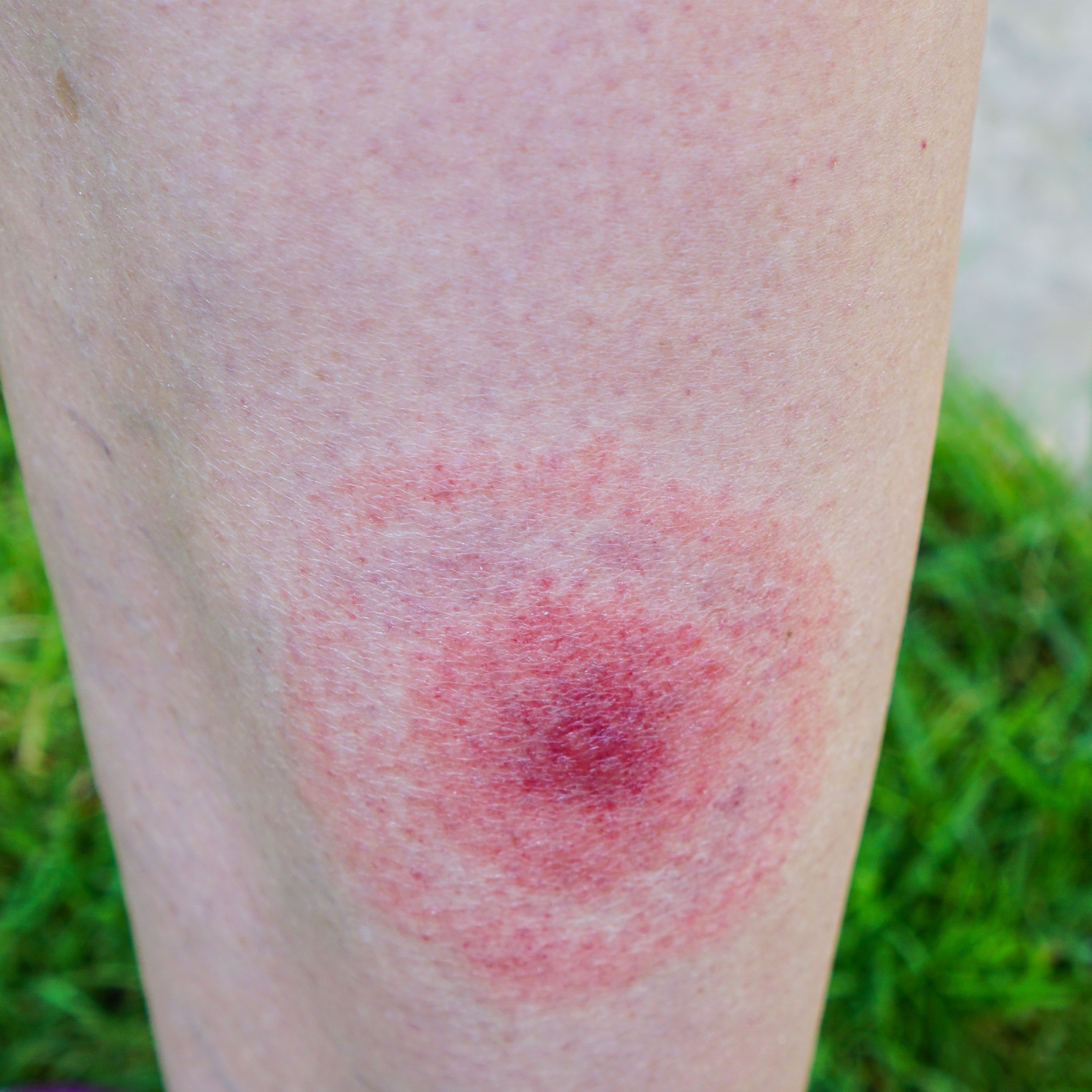 Local woman shares her journey with Lyme disease
