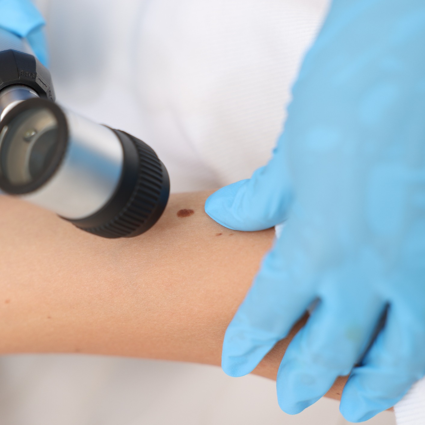 Over 25% of melanomas go undetected until after they've spread