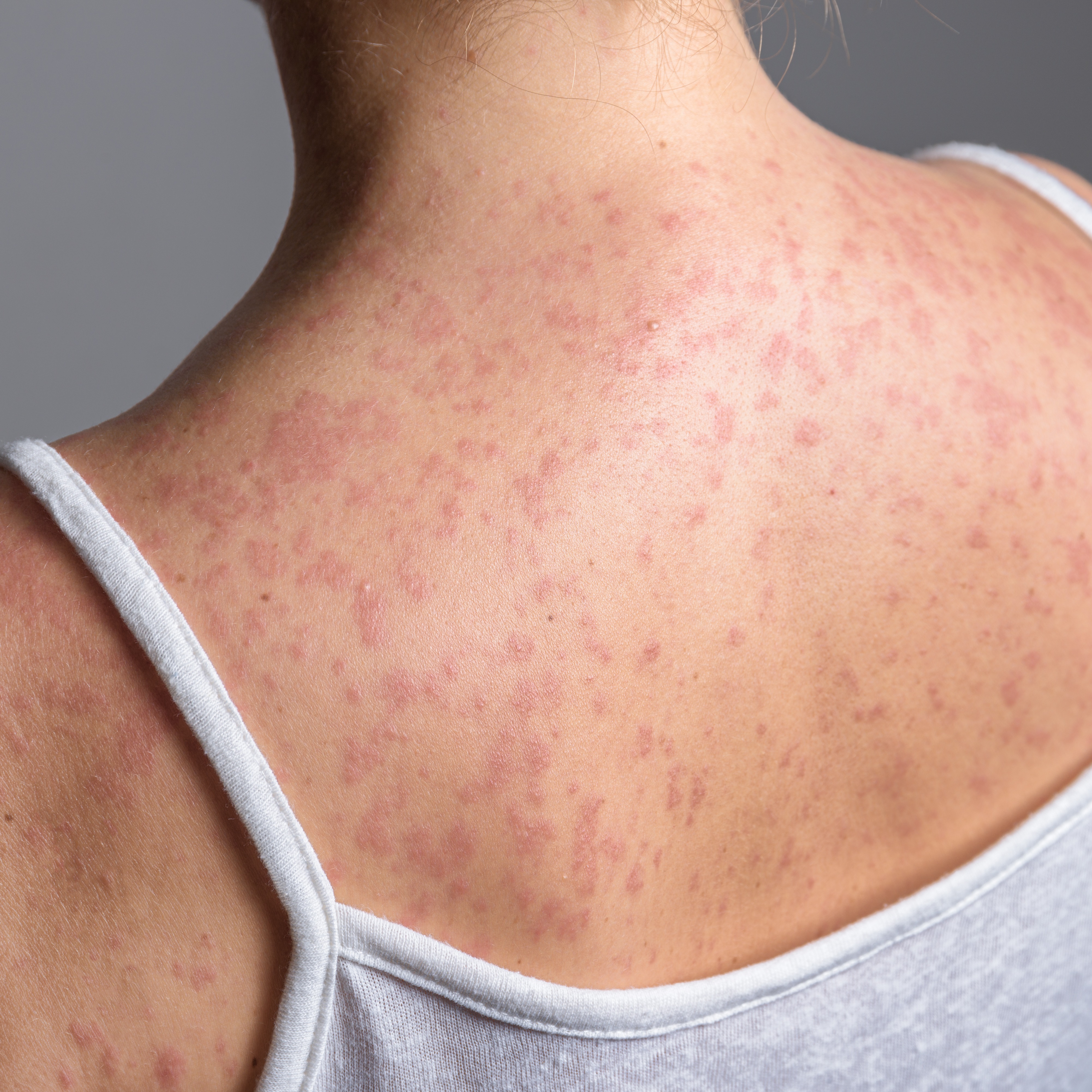What can be done as measles cases continue to rise?