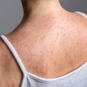 What can be done as measles cases continue to rise?