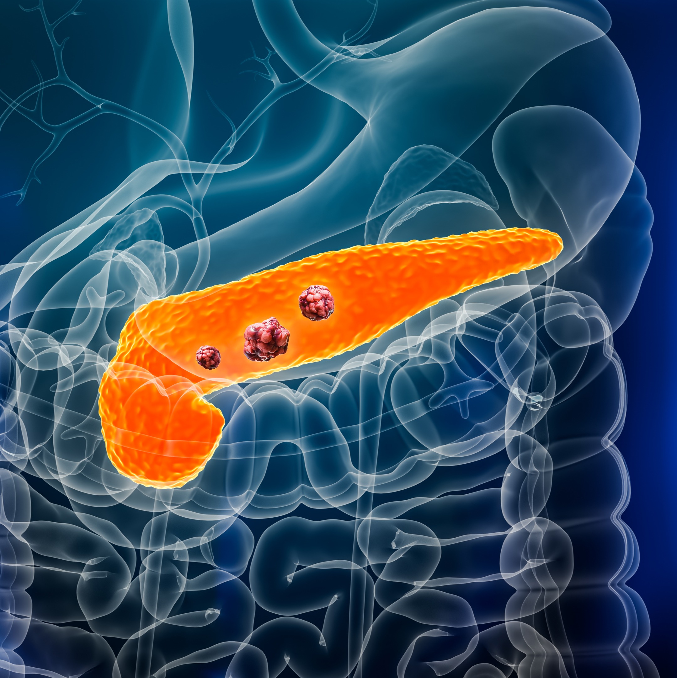 The reality of pancreatic cancer with Dr. Patrick Dreyer, MN Oncology