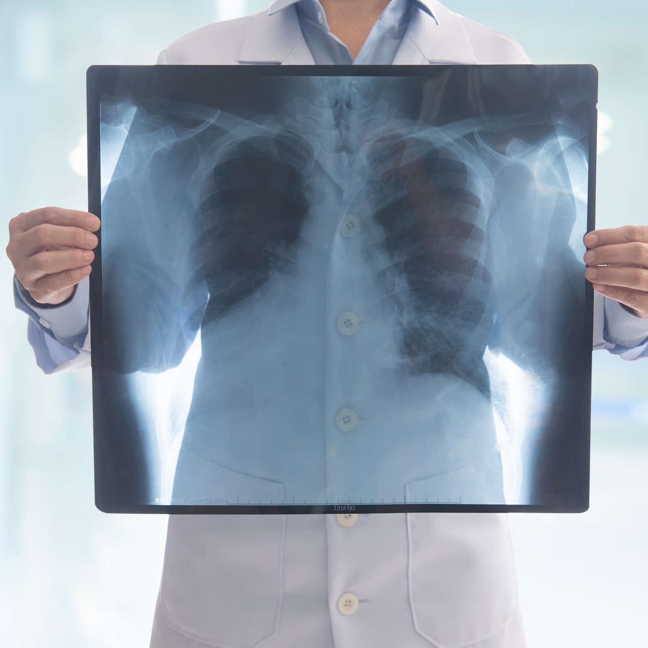 Thoracic Oncology, Brain Health and Livea!