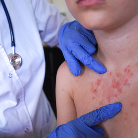 Measles is surging in the US despite a safe way to prevent it