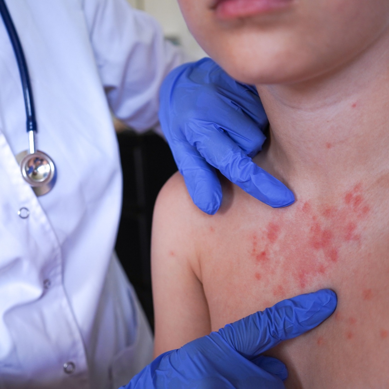 Hochul declares upstate NY measles outbreak a ‘disaster emergency’