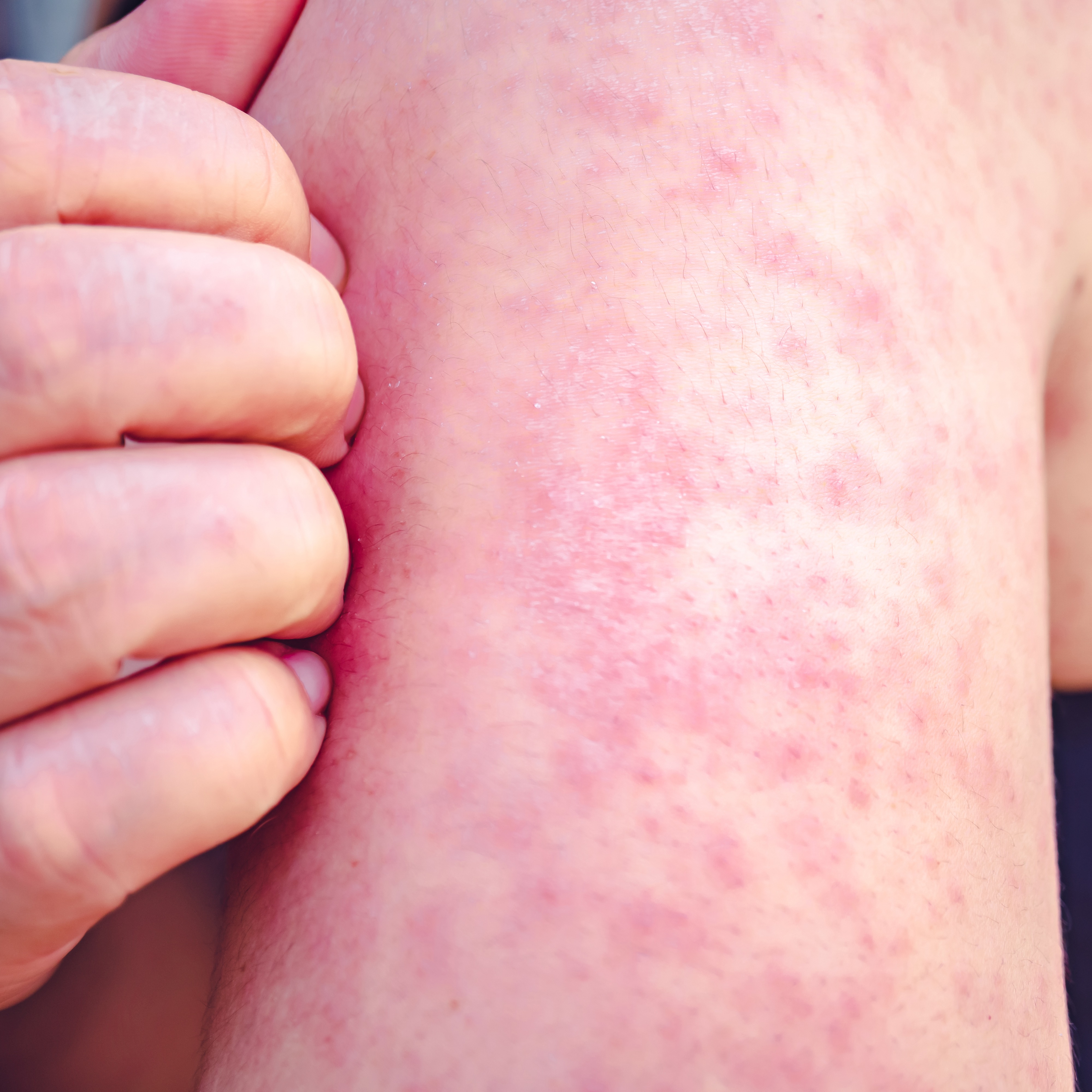 Delaware County officials urge caution, vaccination after measles is found in wastewater samples