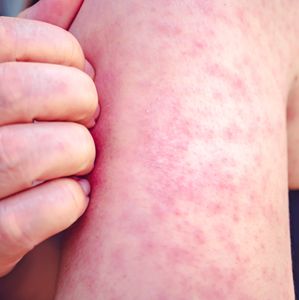 Delaware County officials urge caution, vaccination after measles is found in wastewater samples