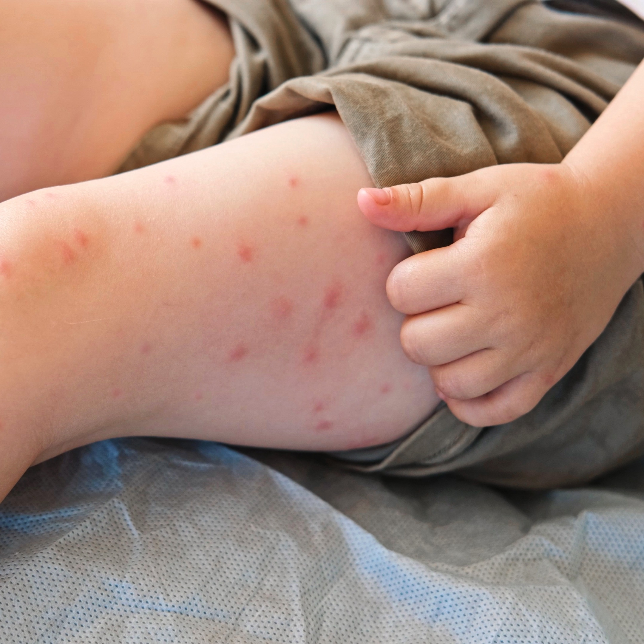 With measles cases on the rise, Pa. health officials recommend getting vaccinated to protect yourself and others