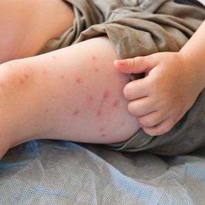 With measles cases on the rise, Pa. health officials recommend getting vaccinated to protect yourself and others