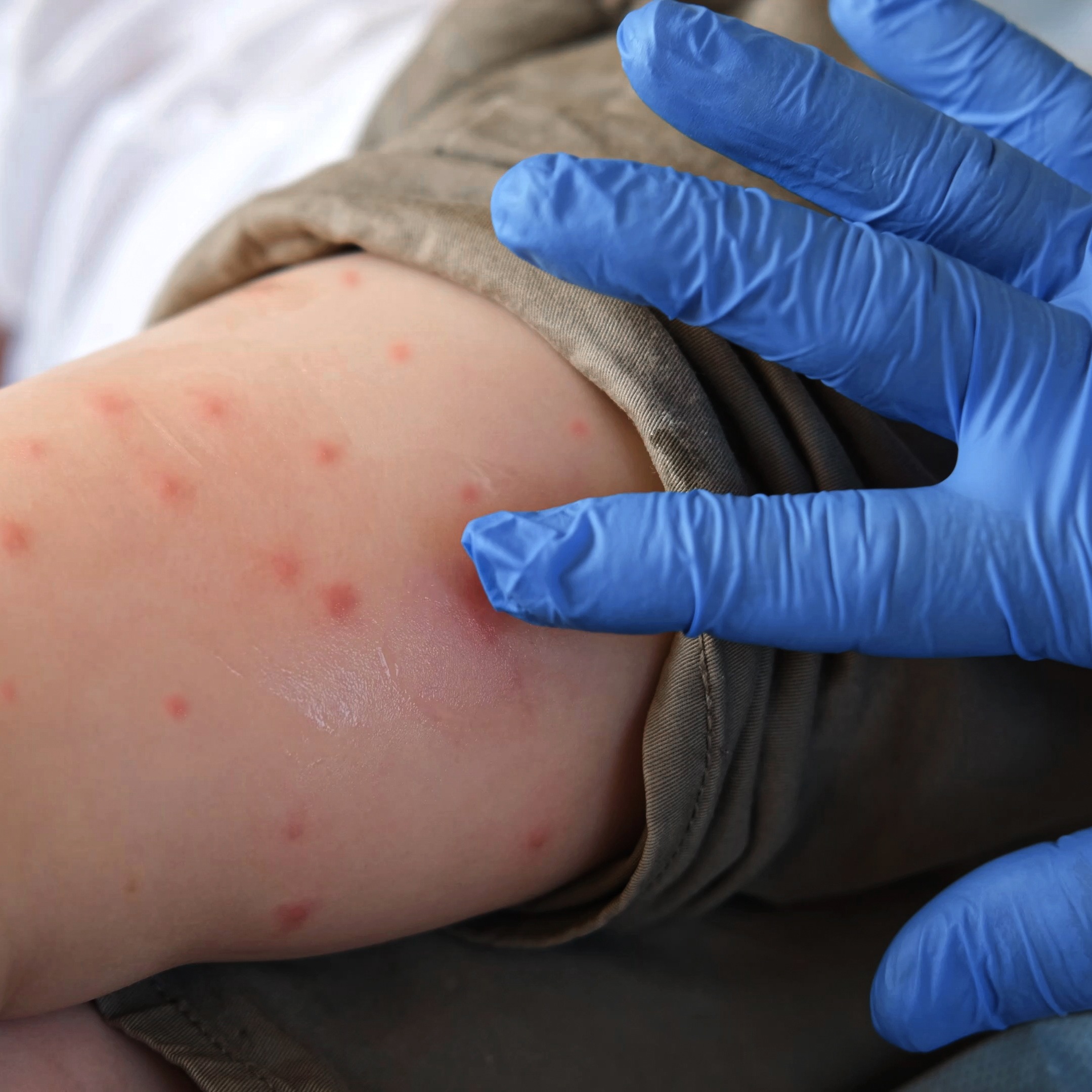 Health officials warn of possible measles exposure at PHL