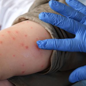 Health officials warn of possible measles exposure at PHL