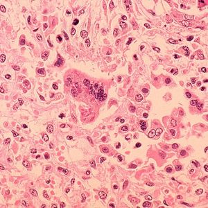 Pennsylvania surpasses 900 measles cases